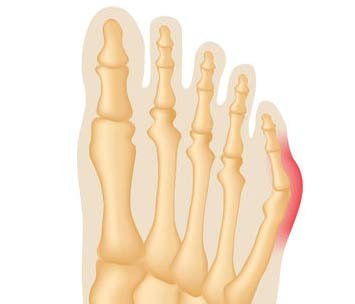 Tailor's Bunion