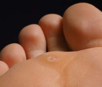 Warts